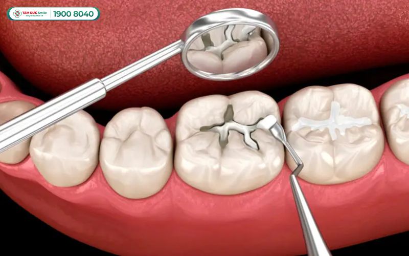 Amalgam – Độ bền cao, dùng cho răng hàm