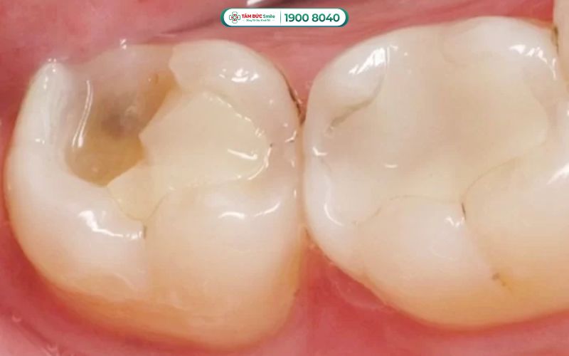 Miếng trám bị vỡ