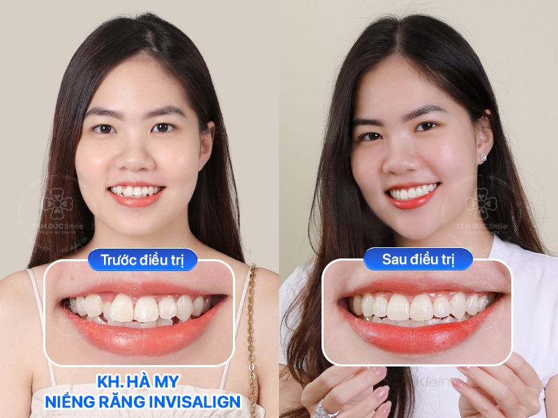 Hình ảnh trước và sau Abc87 tải ứng dụng Invisalign của khách hàng Hà My