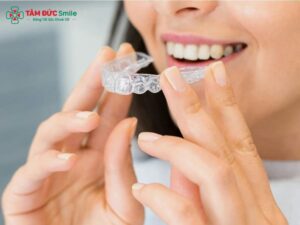 Hàm duy trì sau niềng: Đeo bao lâu, chọn loại nào, cách vệ sinh ra sao?