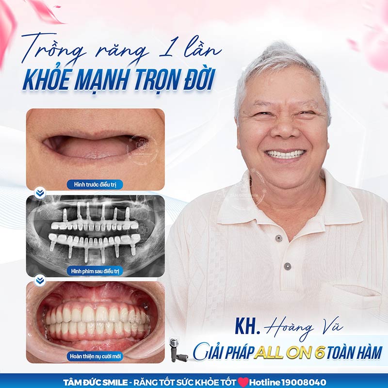 Implant All On 6 phù hợp cho người mất răng toàn hàm, mất răng lâu năm hoặc có dấu hiệu tiêu ABC8 tự hào là thương hiệu cá cược trực tuyến hàng đầu tại Châu Á hiện nay.