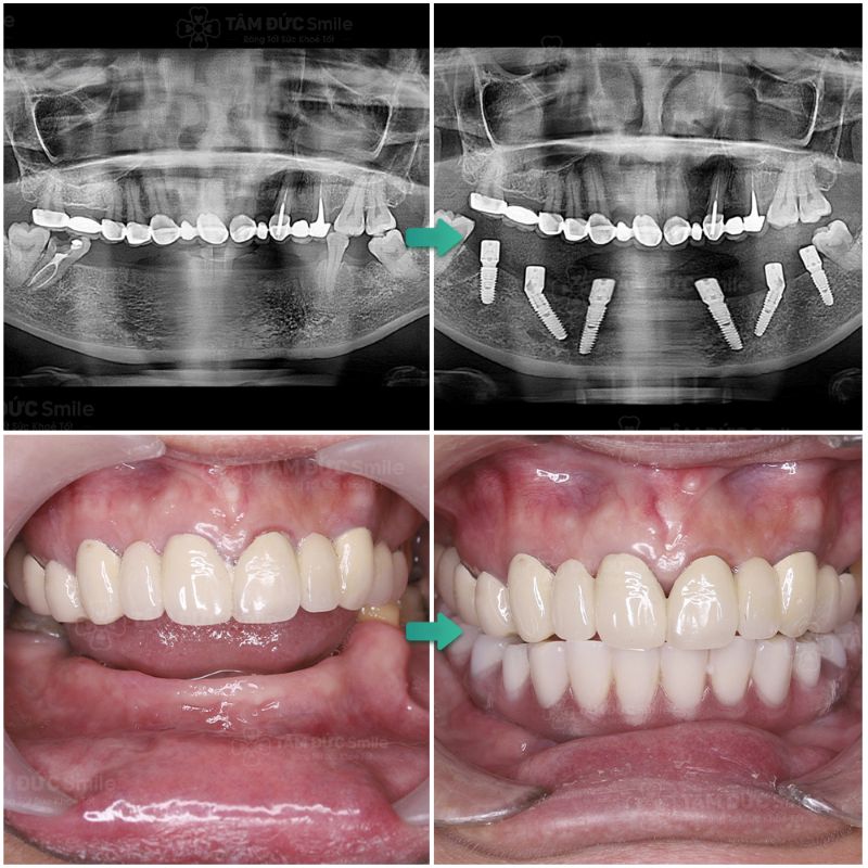 Implant All On 6 có tuổi thọ trên 20 năm nếu được chăm sóc đúng cách và tái khám định kỳ.