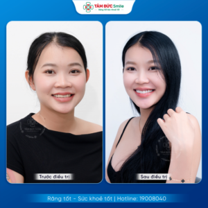 lam-rang-su-o-dau-tot-tai-quy-nhon-nha-khoa-tam-duc-smile-cong-nghe-hien-dai-1153