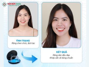loi-ich-cua-nieng-rang-invisalign-2