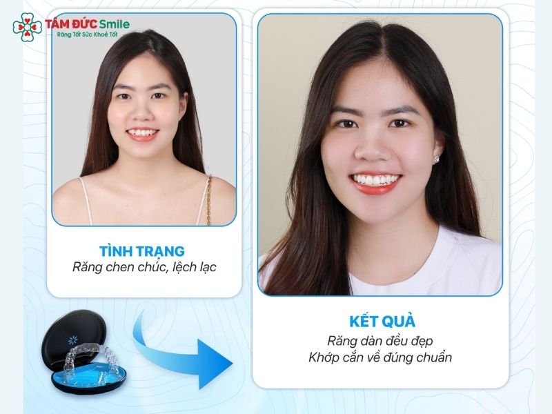 loi-ich-cua-nieng-rang-invisalign-2