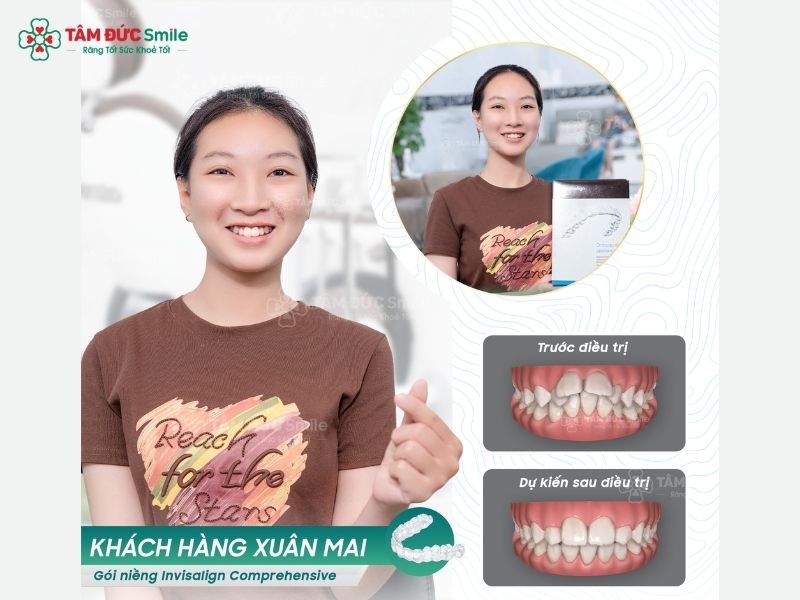 loi-ich-cua-nieng-rang-invisalign-5