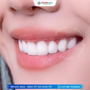 mat-dan-su-veneer-gia-bao-nhieu-tien-652-2