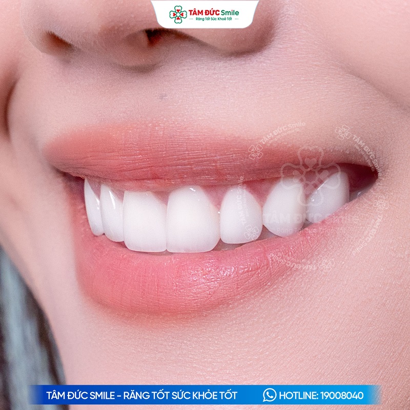 mat-dan-su-veneer-gia-bao-nhieu-tien-652-2