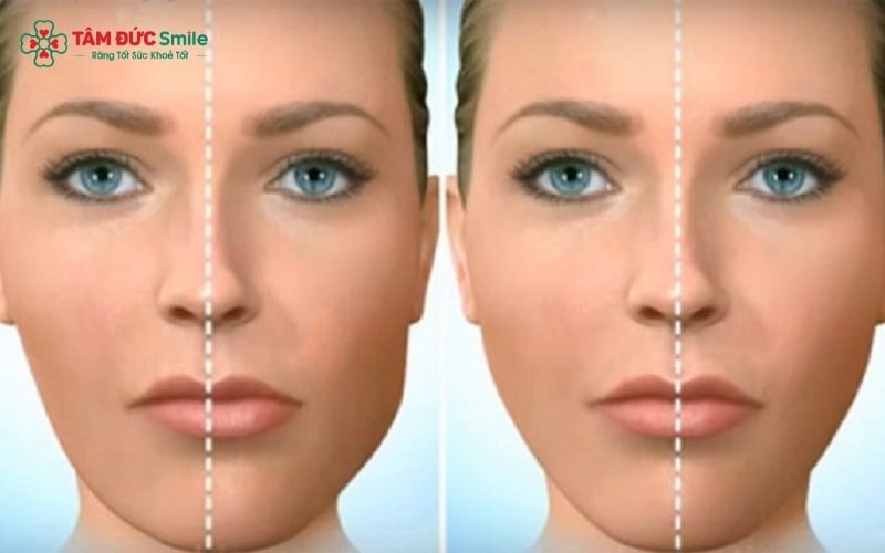 Có nhiều nguyên nhân có thể khiến mặt bị lệch