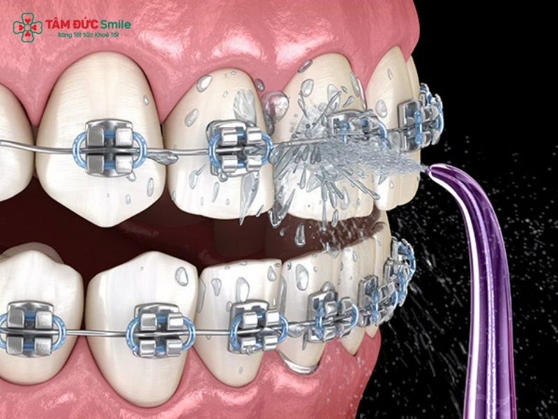 Máy tăm nước sử dụng tia nước có áp lực mạnh để làm sạch kẽ răng, mắc cài