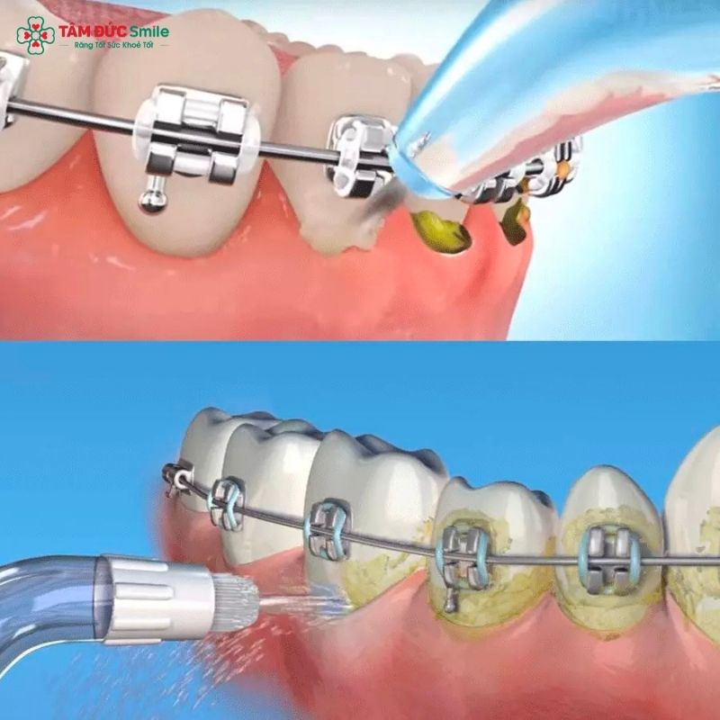 Dùng máy tăm nước khi niềng giúp ngăn ngừa viêm nướu, tiết kiệm thời gian vệ sinh