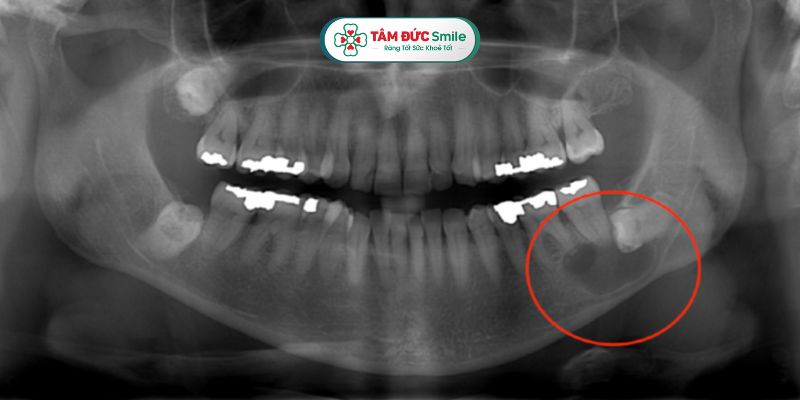 Abc87 nền tảng cá cược trực tuyến có thể chỉ định chụp X-quang quanh chóp để chẩn đoán nang Abc8com giaitri tructuyen