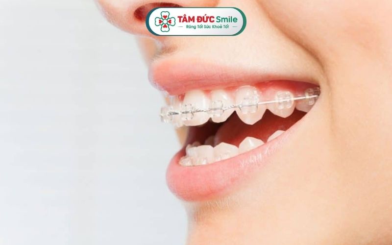 Nẹp răng còn được gọi là Abc888k vip truy cập nhanh, là phương pháp điều chỉnh vị trí của răng để giúp khớp cắn đều đặn