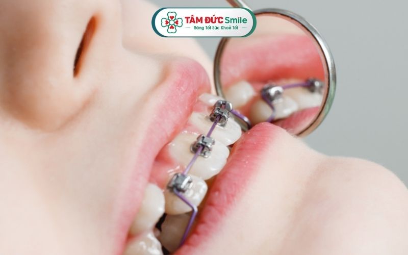 Trẻ em từ 9-14 tuổi đã có thể bắt đầu nẹp răng sớm