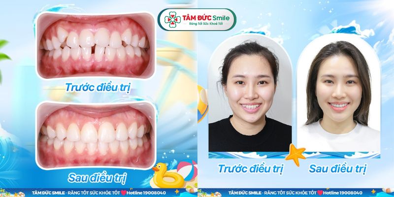 ABC8 ✅ Truy Cập Nhà Cái ABC8 Com Cá Cược Tặng 88k áp dụng quy trình nẹp răng chuẩn y khoa, mang lại hiệu quả cao