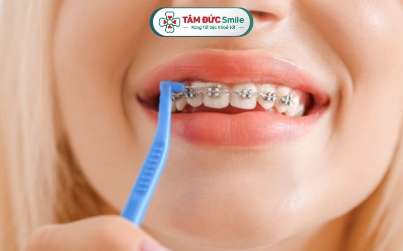Cần chăm sóc răng đúng cách trong quá trình đeo nẹp để đảm bảo hiệu quả