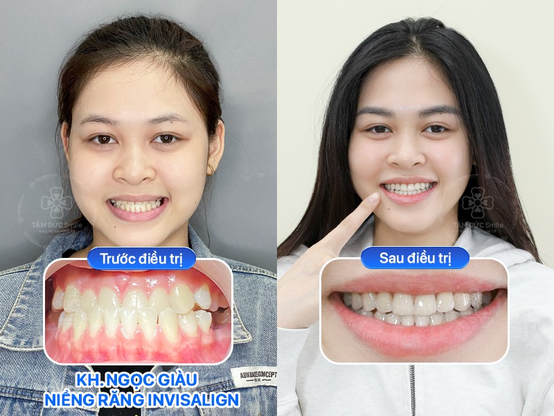 Hình ảnh trước và sau Abc87 tải ứng dụng Invisalign của khách hàng Ngọc Giàu