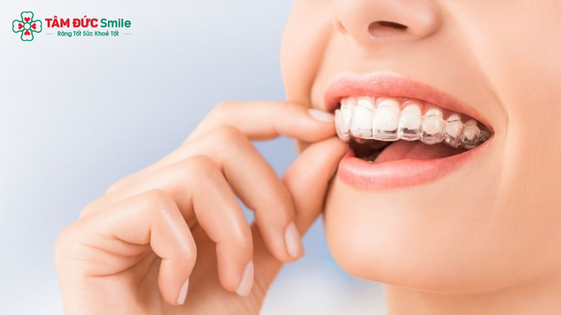 Invisalign – giải pháp Abc87 tải ứng dụng Abc8c1 com khuyến mãi hấp dẫn, linh hoạt và giữ nét tự nhiên