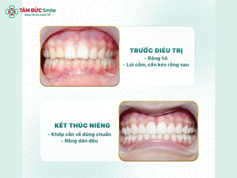 nieng-rang-khong-mac-cai-6