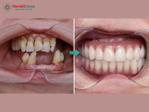 phau-thuat-implant-3