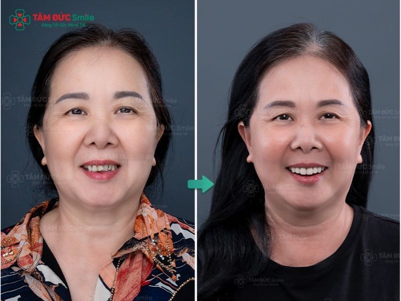 phau-thuat-implant-6