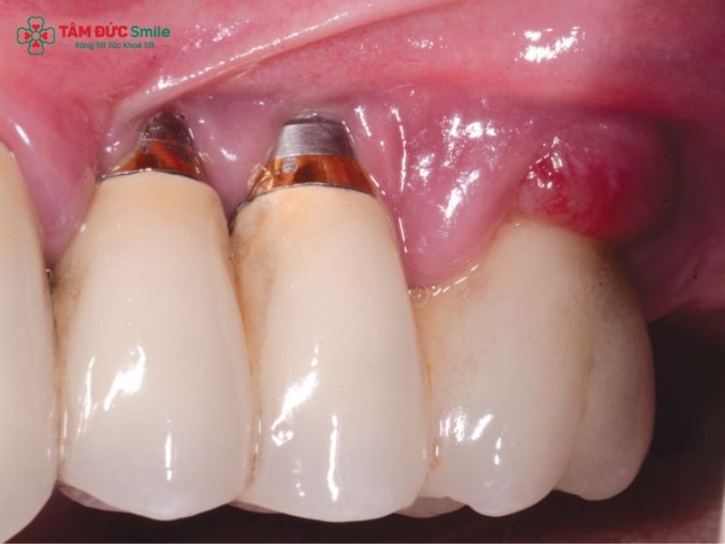 phau-thuat-implant-7