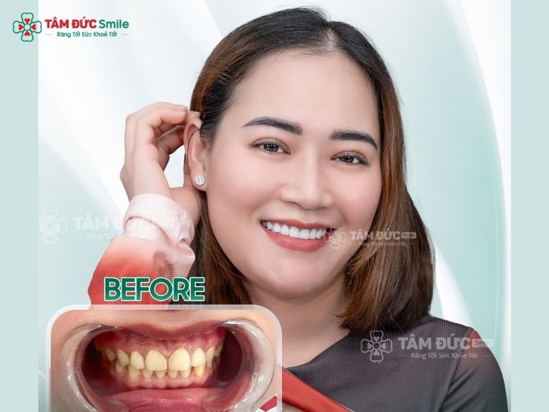 rang-cua-to-6