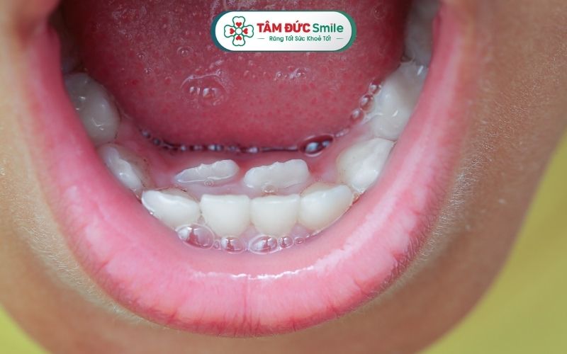 Răng mọc lẫy là hiện tượng khá phổ biến ở ABC8 đường link chính thức, tức là răng vĩnh viễn mọc lệch khỏi vị trí bình thường