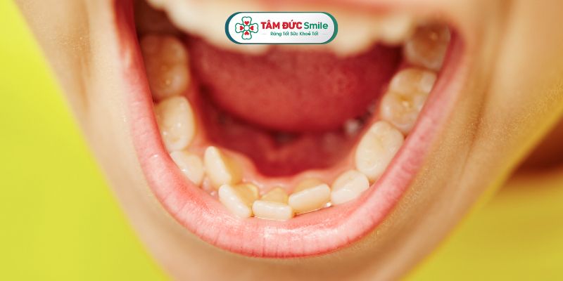 Răng mọc lẫy thường gặp ở răng cửa hàm dưới hoặc hàm trên