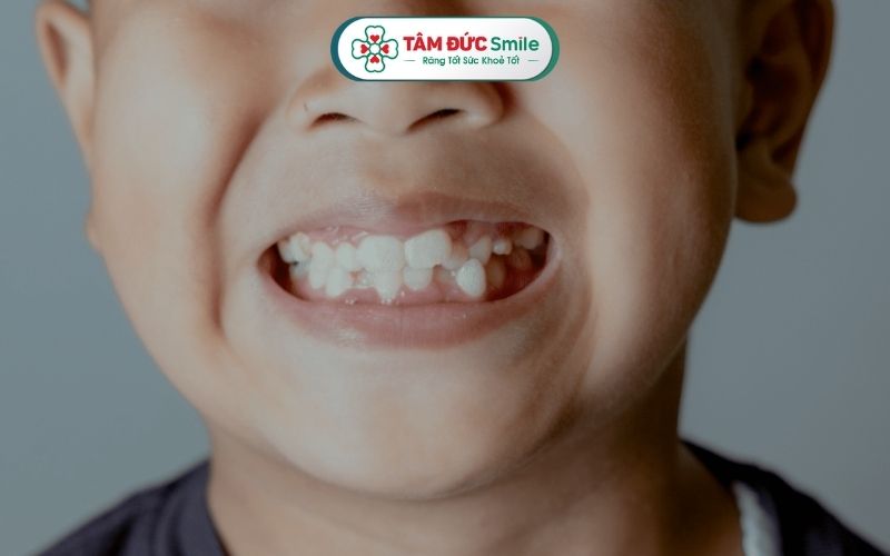 Răng mọc lẫy làm ảnh hưởng Abc8c1 com khuyến mãi hấp dẫn và sức khỏe ABC8 là nhà cái cá cược trực tuyến uy tín số 1 tại Việt Nam