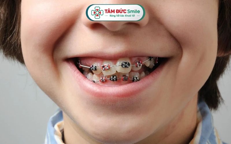 Xử lý răng mọc lẫy từ sớm giúp ngăn ngừa khớp cắn lệch hoặc mất Abc8c1 com khuyến mãi hấp dẫn sau này