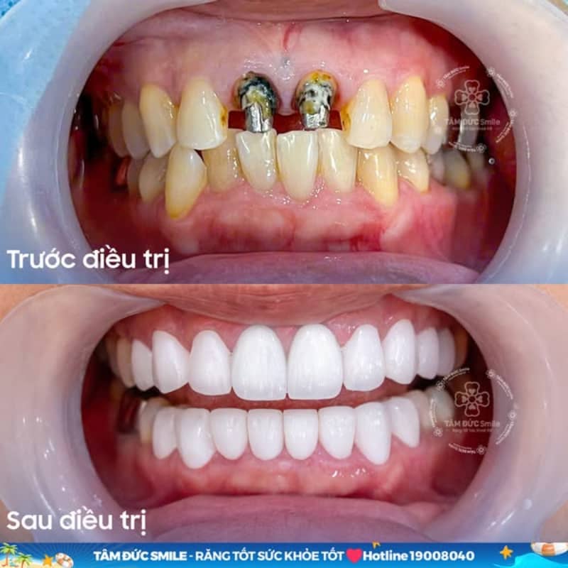 Độ bền cao và Abc8c1 com khuyến mãi hấp dẫn tối ưu với răng toàn sứ