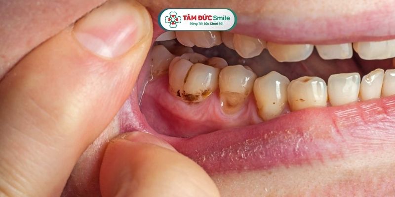 Sâu kẽ răng là dạng ABC88 com đăng nhập phổ biến nhưng khó phát hiện