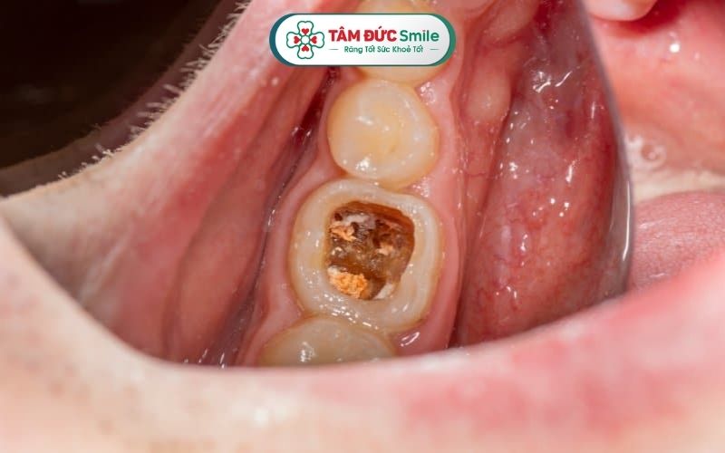 Sâu kẽ răng chia thành nhiều mức độ khác nhau, từ nhẹ cho đến nghiêm trọng