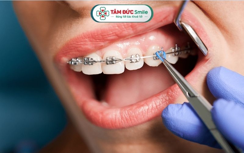 Siết răng chỉ gây đau nhẹ, nhưng nếu cơn đau kéo dài không khỏi thì nên đến gặp ABC8 đường link chính thức