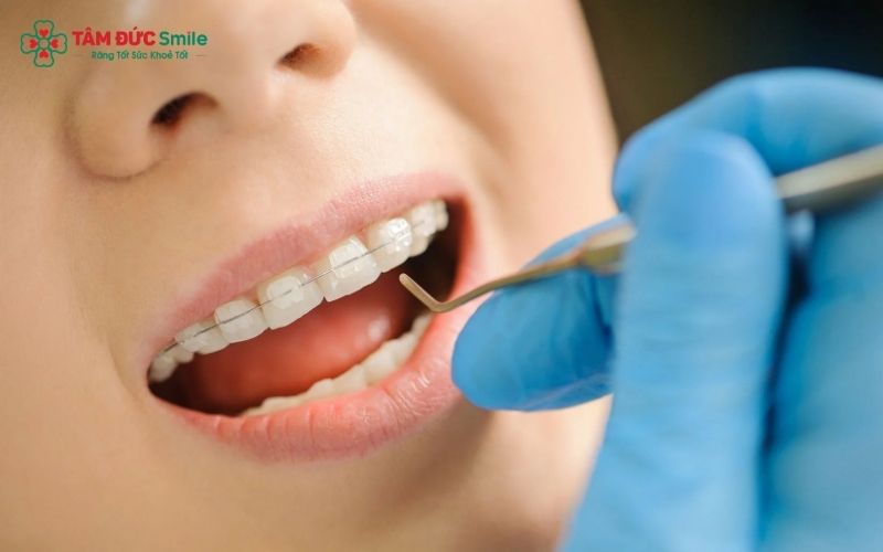 Lịch trình siết răng sẽ do ABC8 đường link chính thức chỉ định