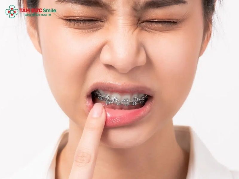Siết răng khi niềng thường gây ê nhẹ trong khoảng 1-3 ngày