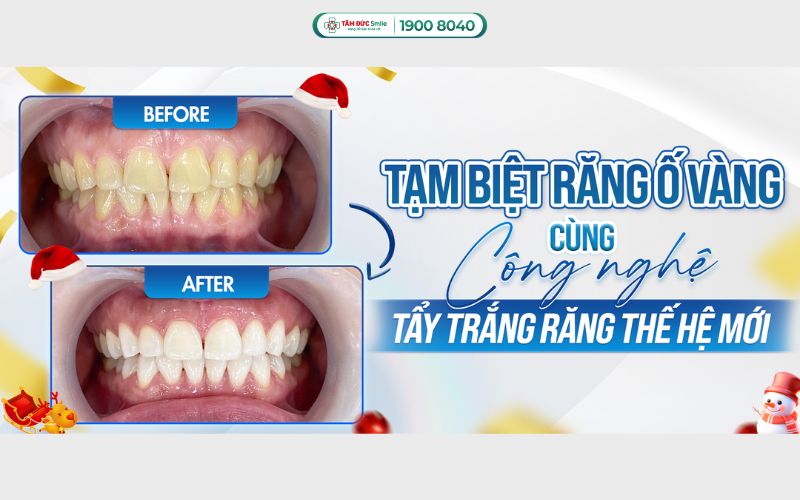 tay-trang-rang-tphcm-1