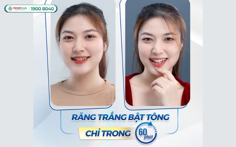 tay-trang-rang-tphcm-3