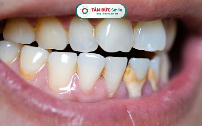 Thiểu sản men răng khiến men răng bị mỏng, thiếu hụt, không hình thành đầy đủ