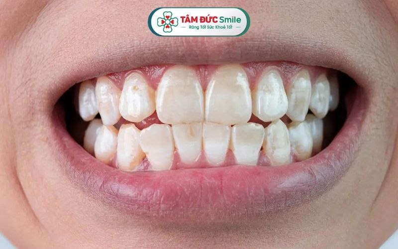 Một số biểu hiện khi bị thiểu sản men răng có thể là răng đổi màu bất thường, bề mặt răng sần sùi, răng dễ ê buốt...
