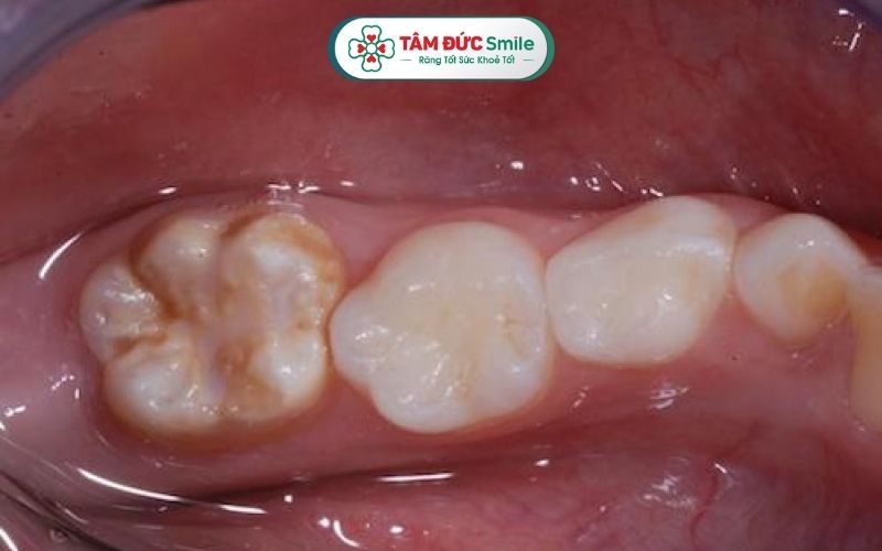 Thiểu sản men răng có thể có liên quan yếu tố di truyền, dùng kháng sinh, rối loạn chuyển hóa...
