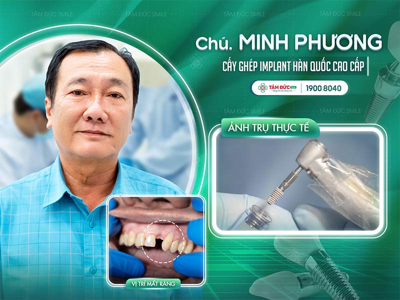 tieu-xuong-rang-bieu-hien-bien-chung-va-cach-phong-ngua-1