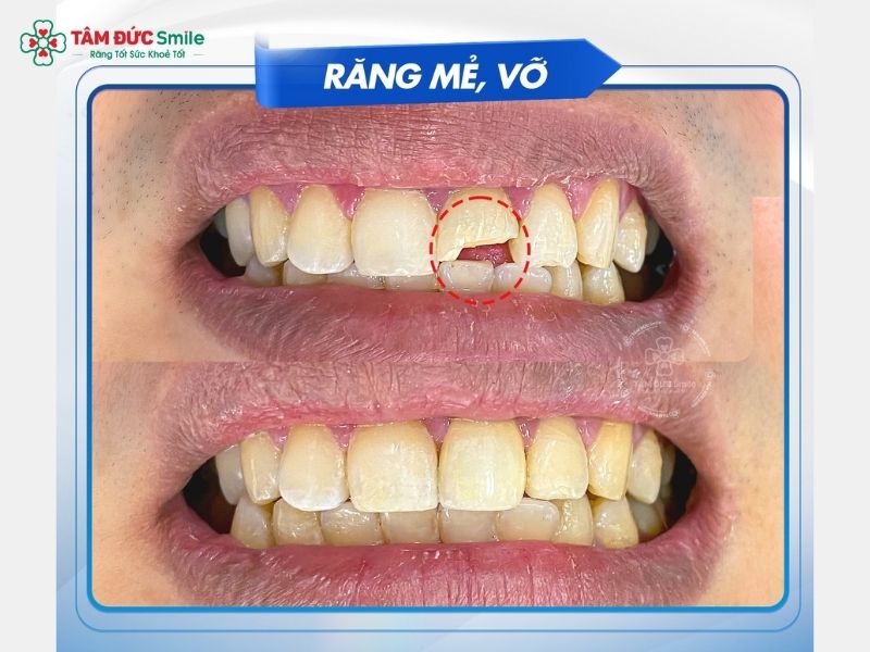 tram-rang-quan-3-2