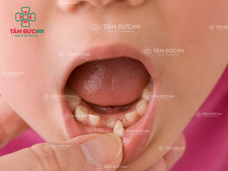 tre-em-co-rang-lung-lay-bao-lau-thi-rung-luu-y-gi-khi-nho-rang-cho-tre-1