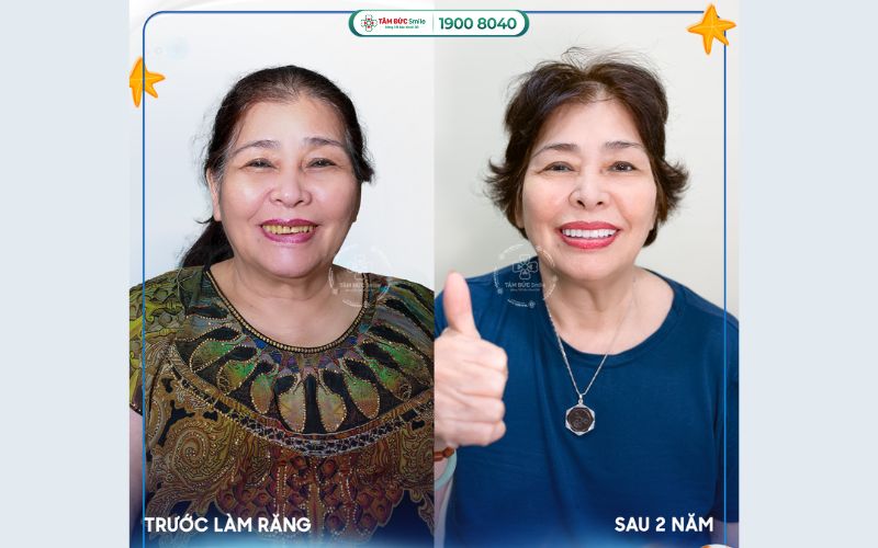 trong-rang-implant-tphcm-1
