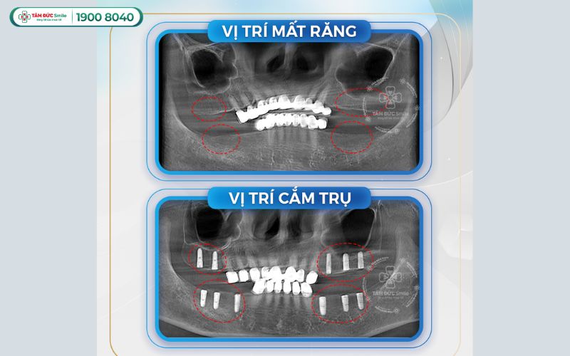 trong-rang-implant-tphcm-4
