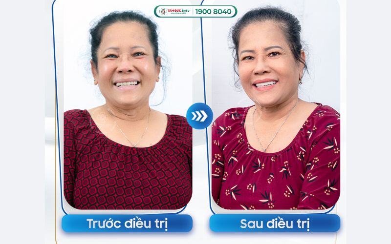 trong-rang-implant-tphcm-5