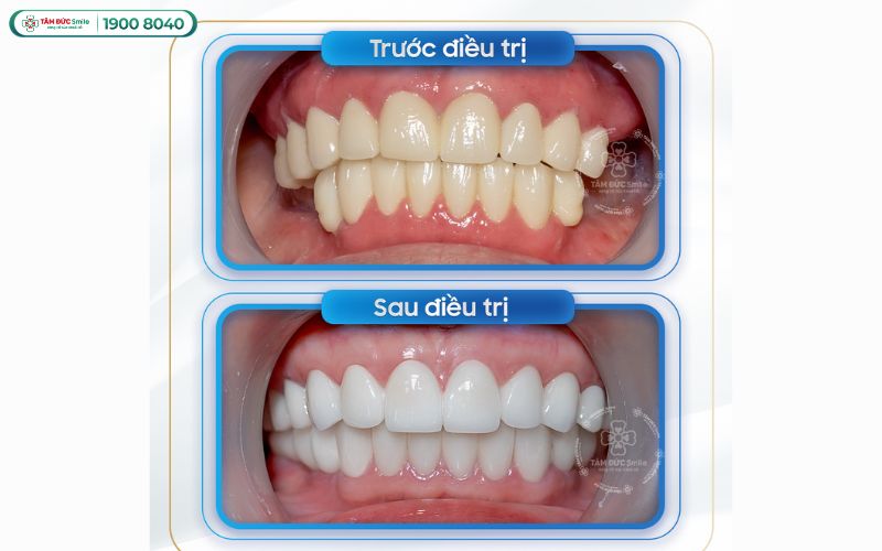trong-rang-implant-tphcm-6