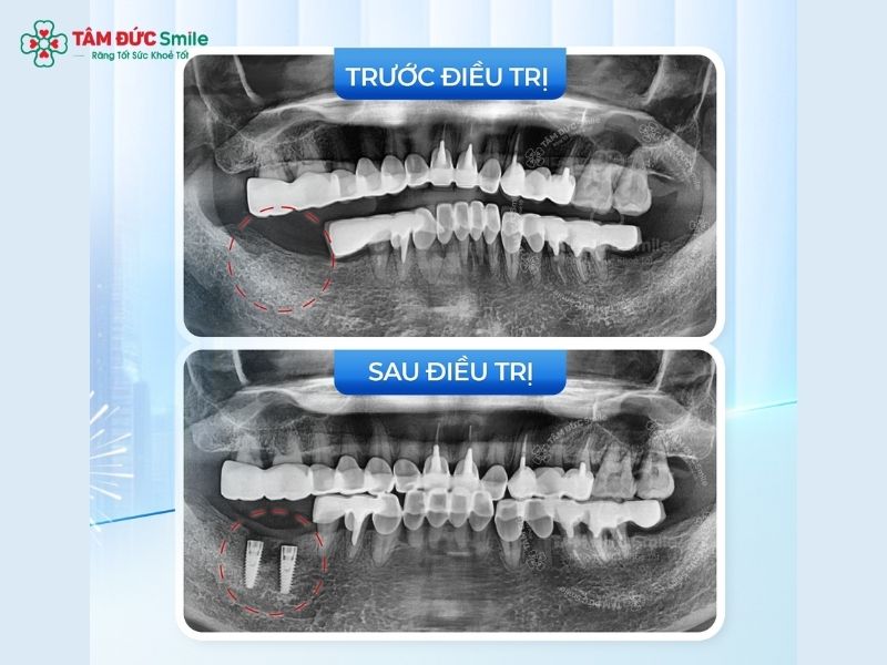 trong-rang-quan-1-2